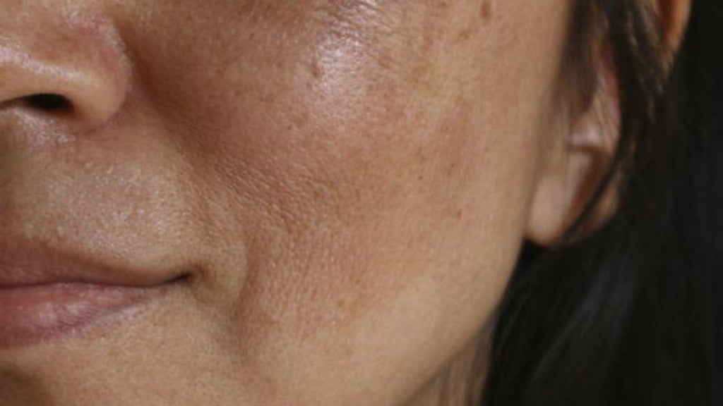 Reprodução/Pinterest Melasma exige cuidados em casa e no consultório