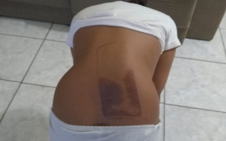 Criança de sete anos sofre queimaduras depois de dormir em cima do celular