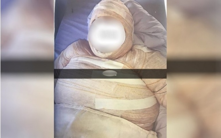Mulher é presa suspeita de atear fogo na namorada por ciúmes