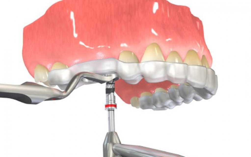 A peri-implantite é a maior causa de perda de implantes dentários