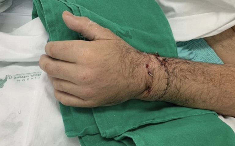 Inspirado em séries médicas, homem 'salva' mão amputada e consegue reimplantá-la