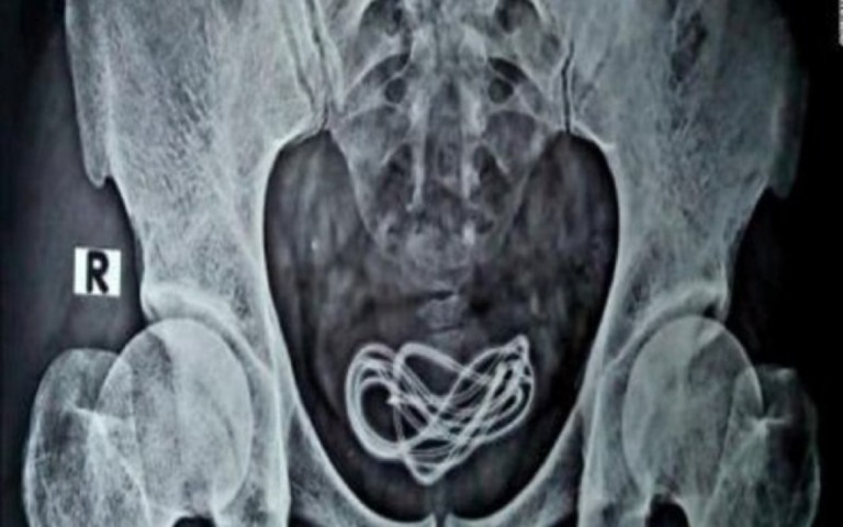 Preso engole dois carregadores de celular e é submetido a cirurgia