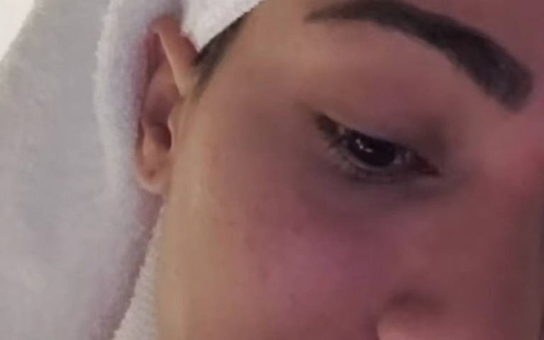 Em dia de show em Nova York, Anitta mostra espinhas no rosto: 'está um Chokito'