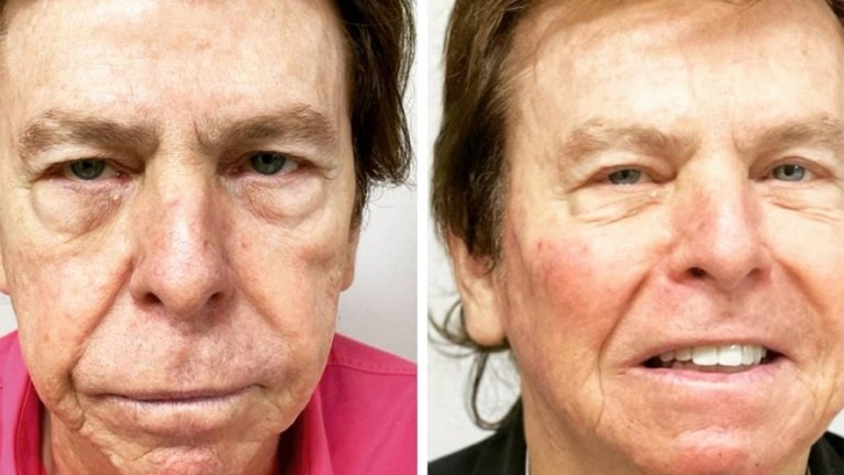 Nelson Rubens mostra resultado de harmonização facial: "Foram 19 injeções"