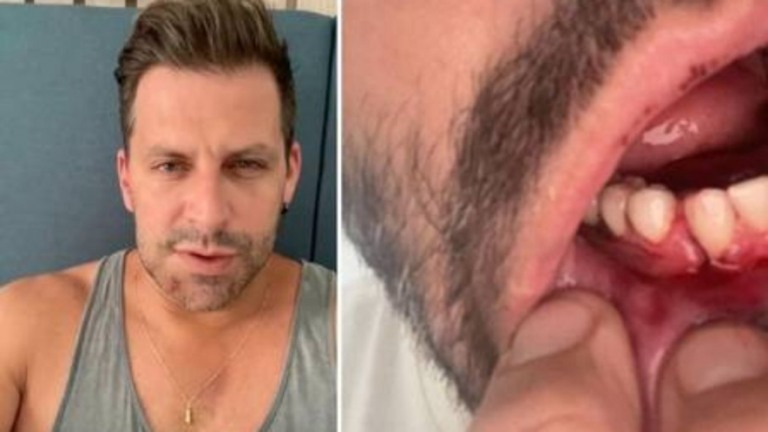 Henri Castelli mostra tratamento na mandíbula e teme por sequelas