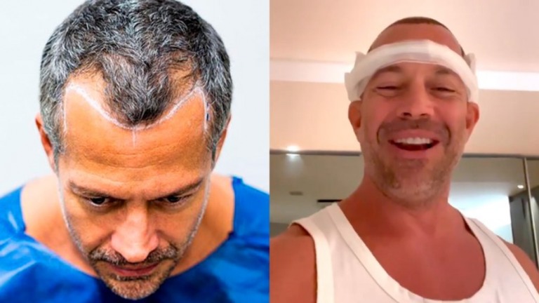 Malvino Salvador faz transplante capilar: "Mantive o desenho das entradas"