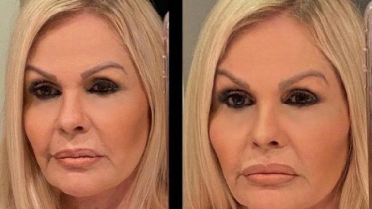 Monique Evans mostra antes e depois de harmonização facial