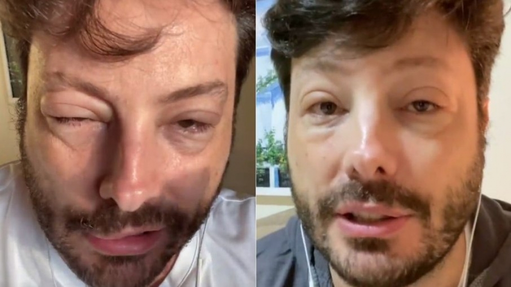 Danilo Gentili surge desfigurado e adianta: "Quase fui pro saco" Danilo Gentili surge desfigurado e adianta: "Quase fui pro saco"