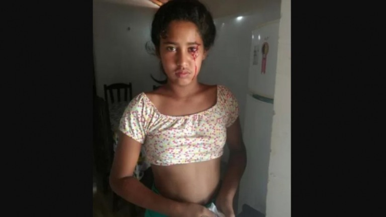 Lágrimas de sangue: menina de 12 anos busca diagnóstico para doença no Piauí