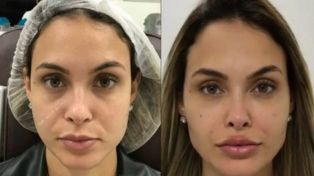 'BBB 21': Sarah Andrade decide mexer no rosto e médico mostra o antes e depois 'BBB 21': Sarah Andrade decide mexer no rosto e médico mostra o antes e depois