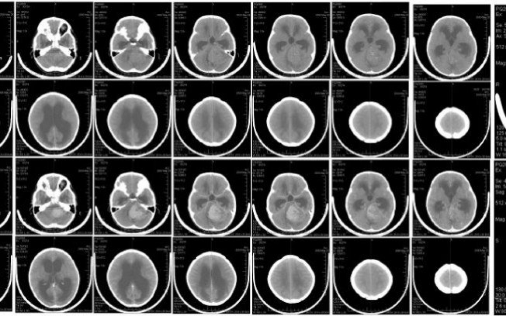 Pesquisadores desenvolvem técnica capaz de matar tumores cerebrais de fome