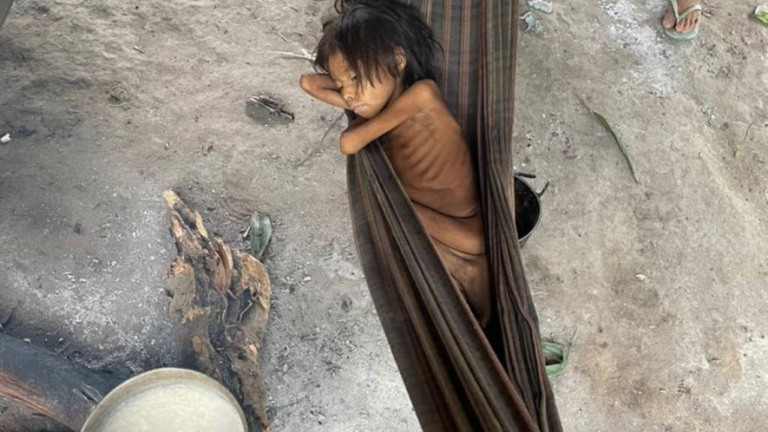 Malária, verminose e desnutrição: indígenas de Roraima sofrem sem assistência
