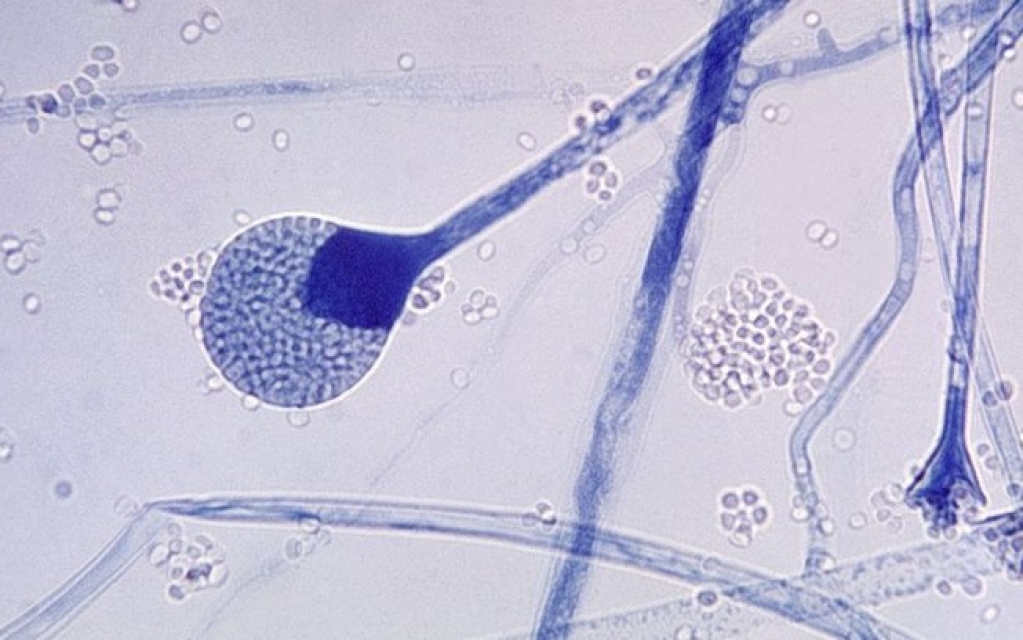 Mucormicose: entenda a infecção que mutila e mata pacientes de Covid na Índia