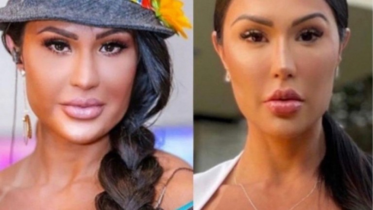 Gracyanne Barbosa mostra resultado de procedimento no rosto
