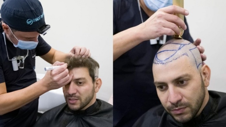 Ex-BBB Caio Afiune faz transplante capilar