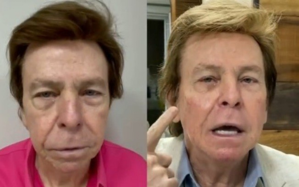 Nelson Rubens entra na onda de harmonização facial; confira o antes e depois