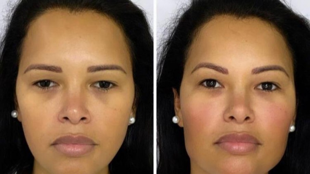 Ariadna Arantes faz harmonização facial para 'marcar mandíbula'; veja resultado Ariadna Arantes faz harmonização facial para 'marcar mandíbula'; veja resultado