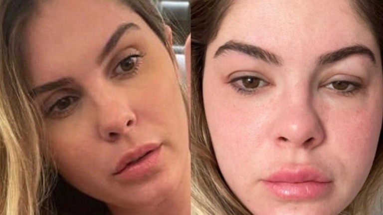 Bárbara Evans surge com rosto inchado por causa de tratamento para engravidar