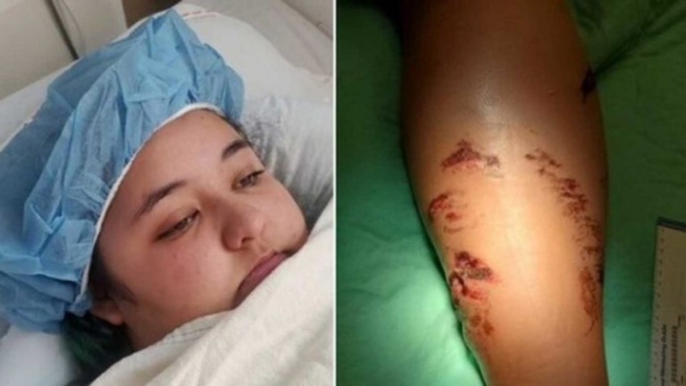 Jovem de 18 anos sobrevive após ser mordida por crocodilo de 3 metros