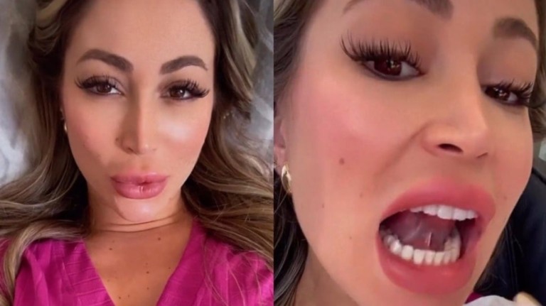 Carol Narizinho faz cirurgia para corrigir língua presa: "Atrapalha para beijar"