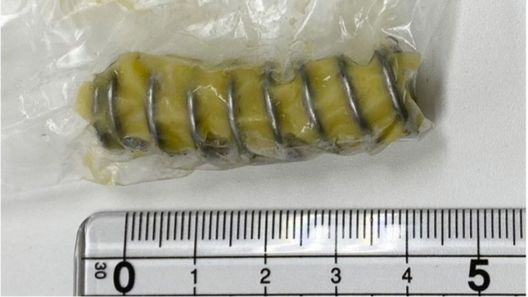 McDonald's deixa peça de metal no hambúrguer e mulher quebra o dente; veja