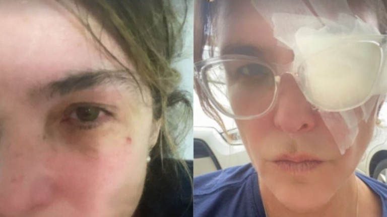 Cristiana Oliveira mostra curativo após sofrer acidente no olho