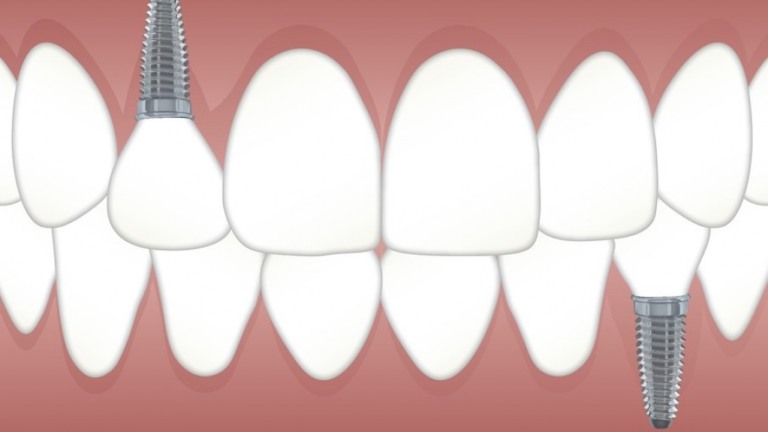 Diabéticos podem colocar implante dental
