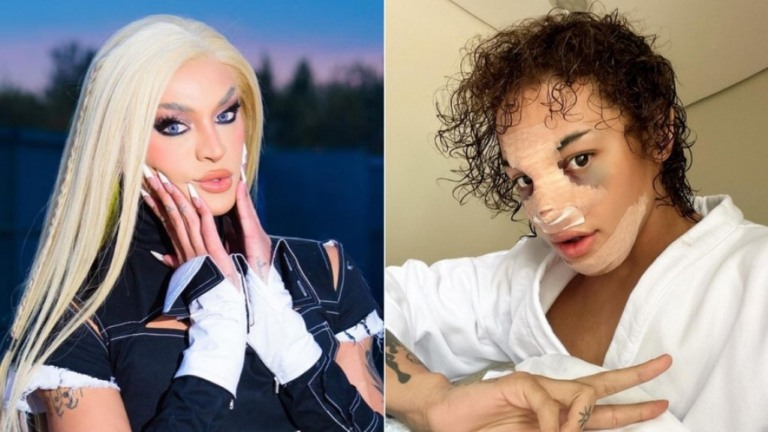 Pabllo Vittar exibe olho roxo e curativo após plástica no nariz; veja