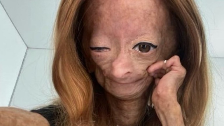 Morre Influenciadora com síndrome rara aos 15 anos