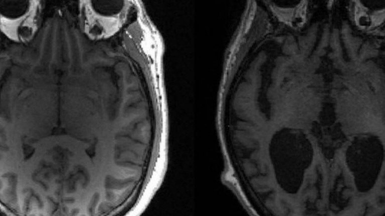 Descoberta brasileira abre caminho para remédios contra o Alzheimer