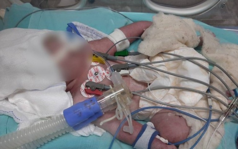 Bebê fica internada após ter couro cabeludo arrancado durante parto