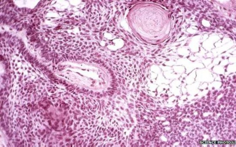 Cientistas espanhóis usam células-tronco em tratamento de pacientes graves