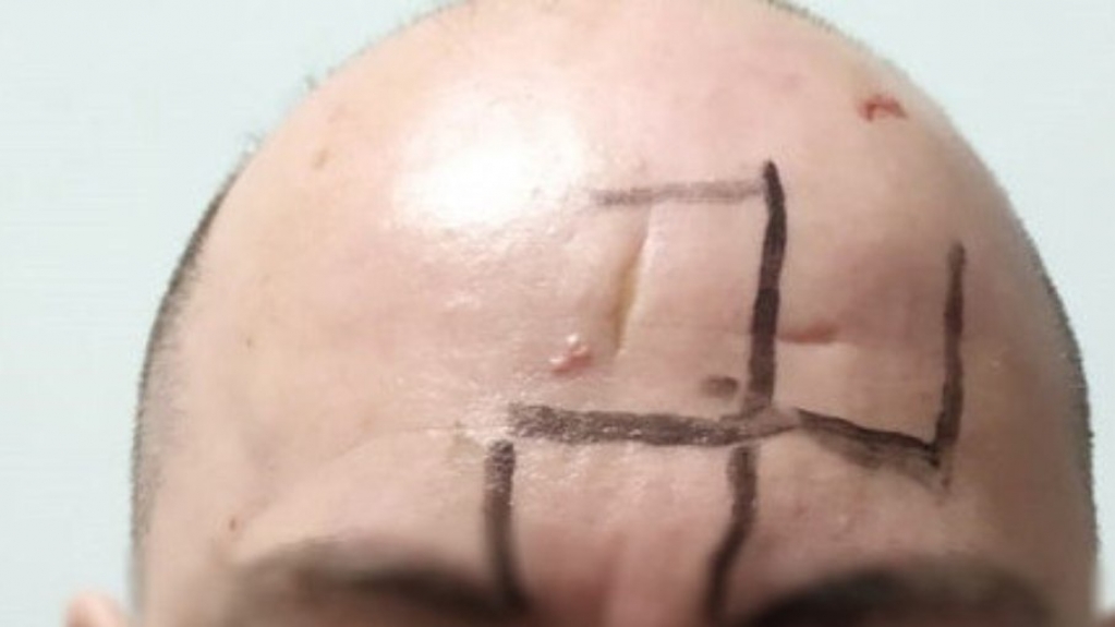Homofobia: Vítima é dopada, agredida e tem suástica desenhada no rosto, em MG Homofobia: Vítima é dopada, agredida e tem suástica desenhada no rosto, em MG