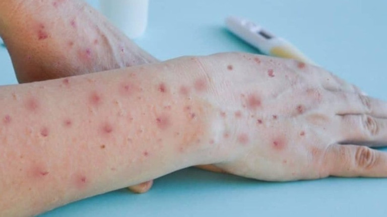 RJ: estado passa de 1,3 mil casos confirmados de mpox