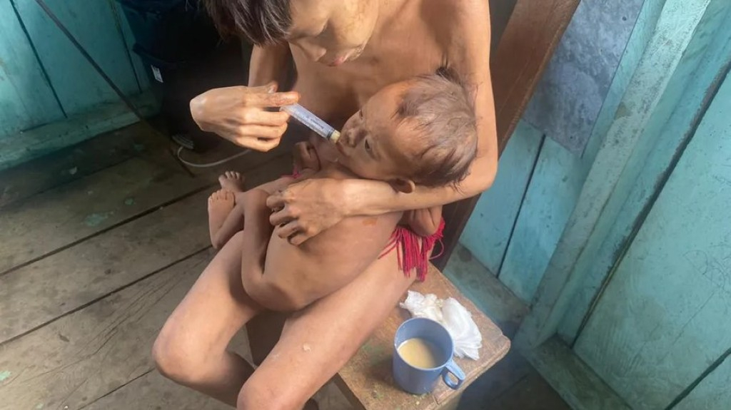 Com desnutrição grave, crianças Yanomami têm peso de bebê Com desnutrição grave, crianças Yanomami têm peso de bebê