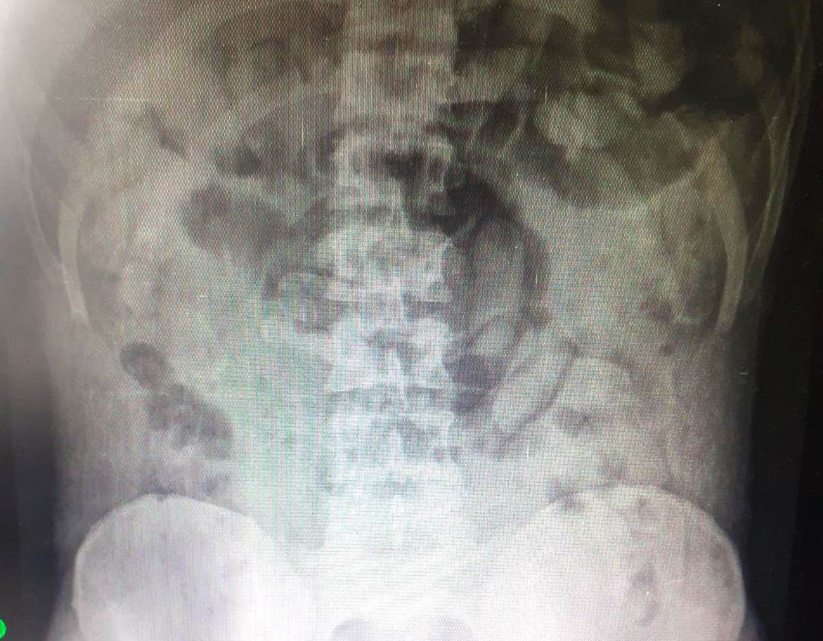 Passageiro foi flagrado com drogas no estômago